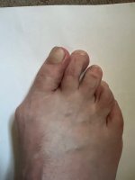 Hallux.jpg